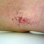 dermatitis legs